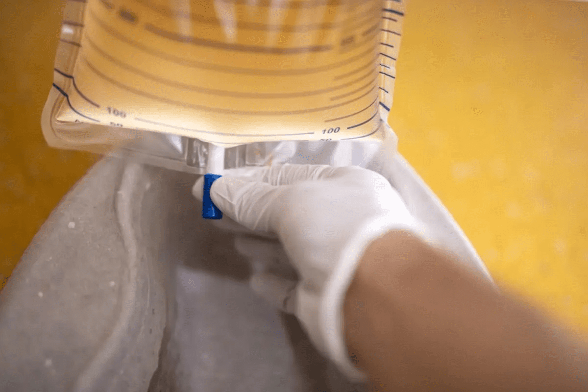 Bile Duct Drainage Bag: 7 Essential Care Facts