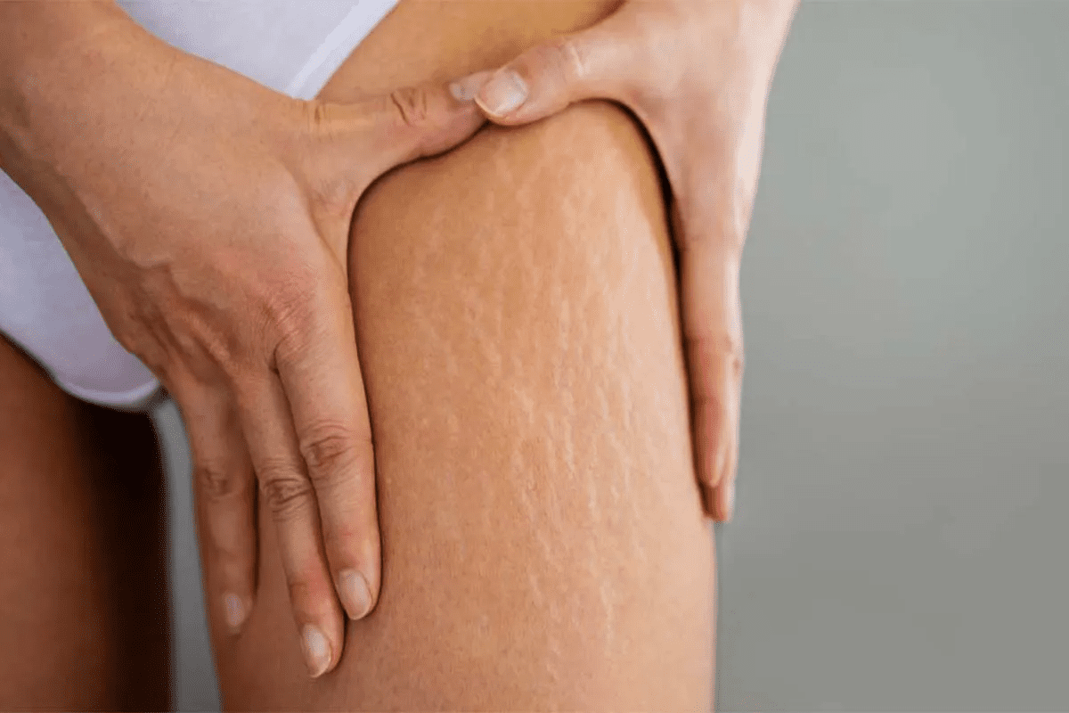 Post Surgery Cellulitis: 7 Alarming, Key Facts