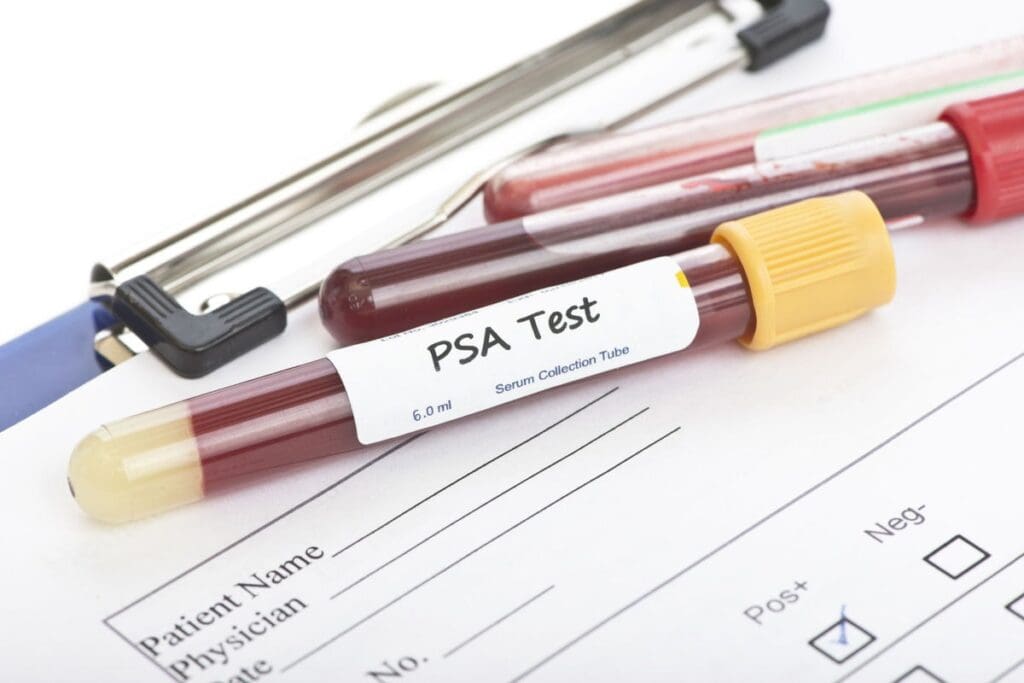 Why PSA Test Is Controversial: 5 Shocking Truths in the PSA Test Controversy 1 Why PSA Test Is Controversial | PSA Test Controversy