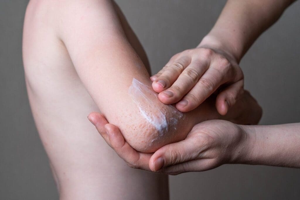 Baby Eczema: 10 Expert-Approved Ways to Protect and Soothe Skin 2 Baby Eczema: 10 Expert-Approved Ways to Protect and Soothe Skin