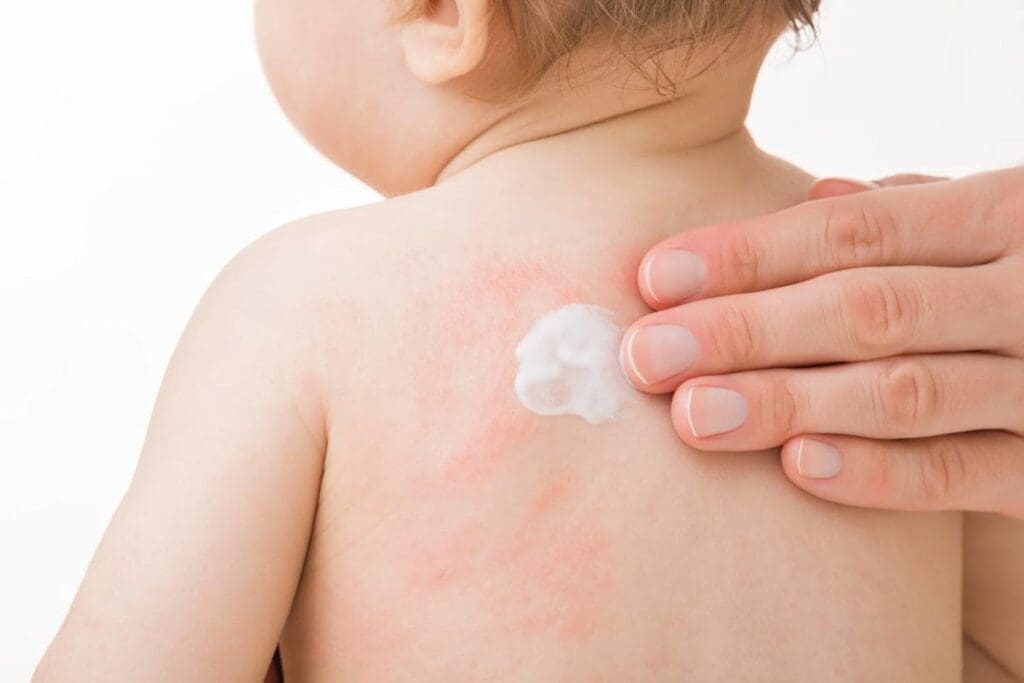 Baby Eczema: 10 Expert-Approved Ways to Protect and Soothe Skin 3 Baby Eczema: 10 Expert-Approved Ways to Protect and Soothe Skin