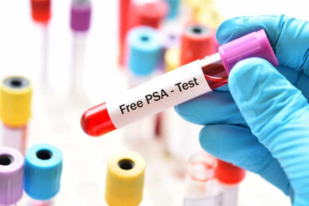 Why PSA Test Is Controversial: 5 Shocking Truths in the PSA Test Controversy 2 Why PSA Test Is Controversial | PSA Test Controversy