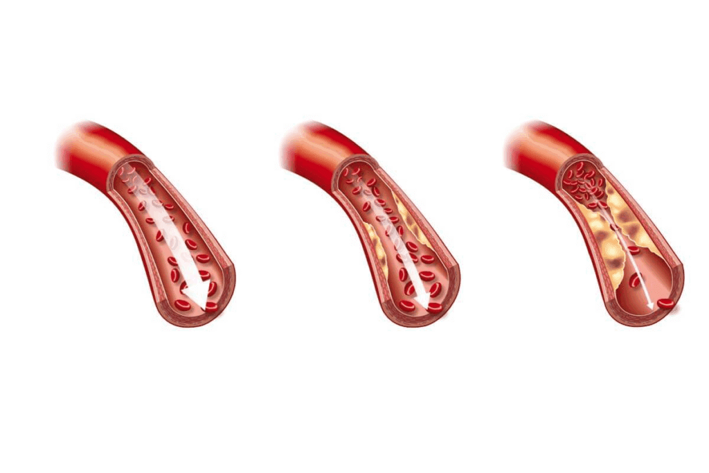 How Many Stents Can Be Placed in One Artery?