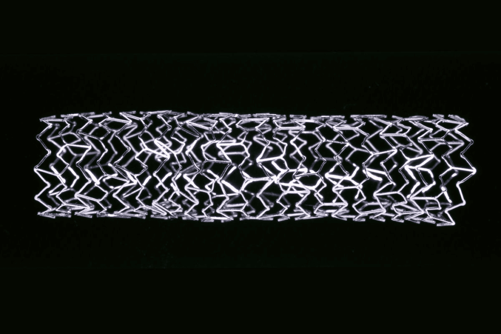 How Many Stents Can a Person Get? Expert Facts