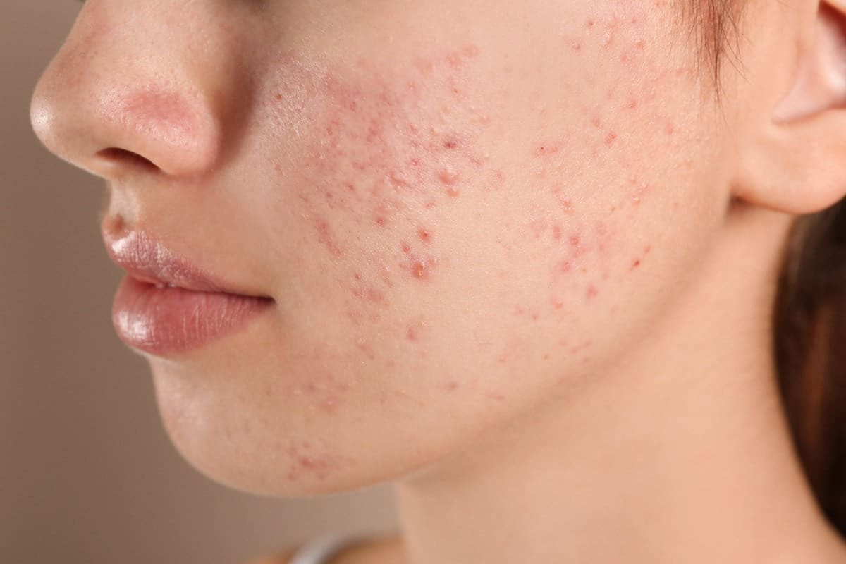 How to Get Rid of Acne: Proven Secrets for Success