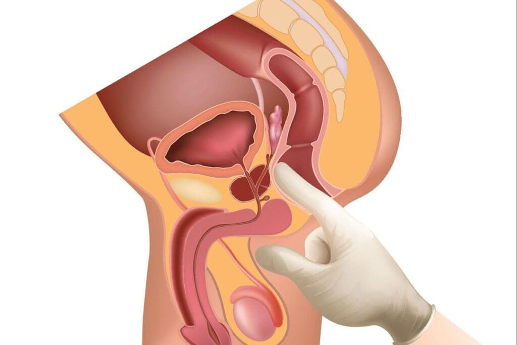 Is Prostate Biopsy Painful? | What to Expect