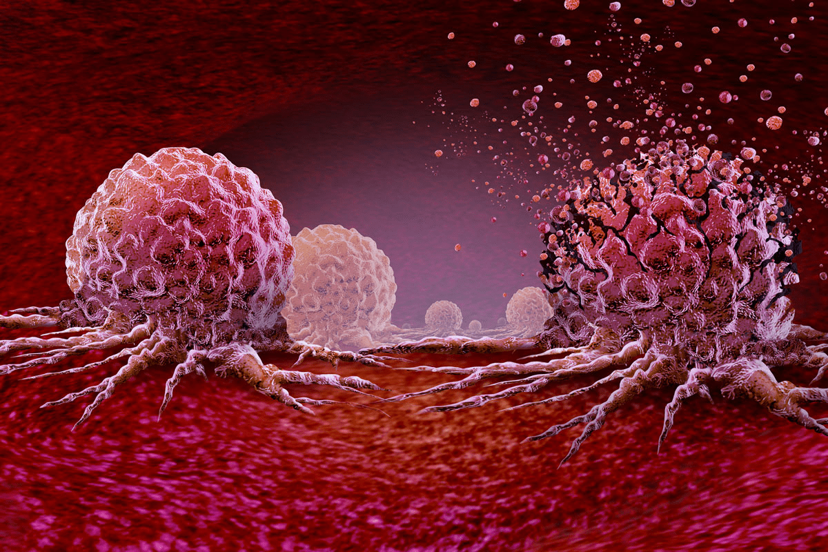 What Is Cryosurgery for Cancer and How Does This Treatment Freeze Cancer Cells?