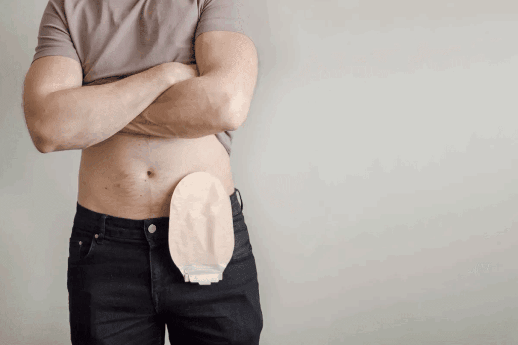 Caring for a Colostomy: Step-by-Step Care Guide
