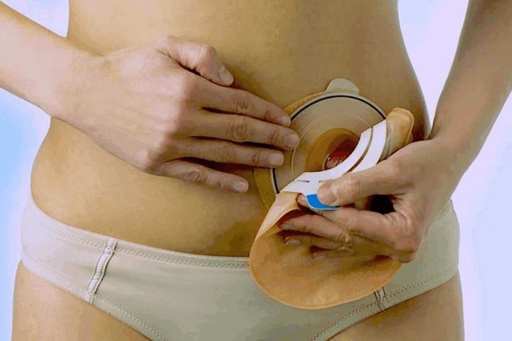 Caring for a Colostomy: Step-by-Step Care Guide
