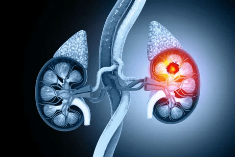 Kidney cancer removal: 5 Critical Surgery Steps