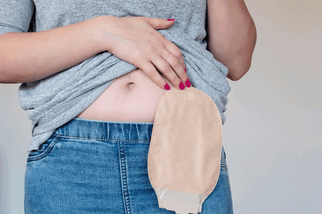 Colostomy Bag Hole: How to Cut Perfectly