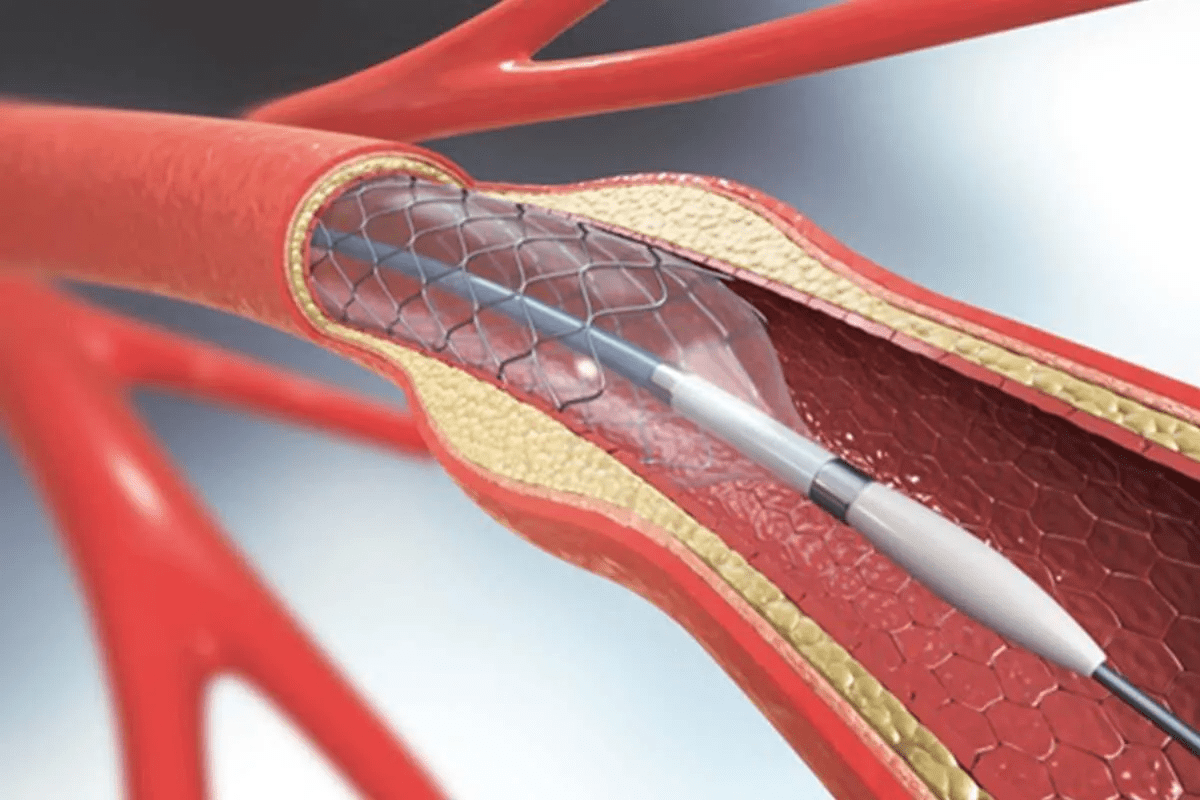 Fenestrated Endovascular Aortic Repair Explained