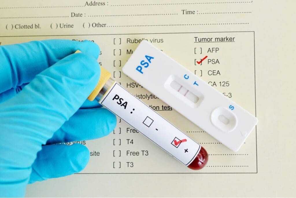 Does Arousal Increase PSA? | Prostate Arousal Facts