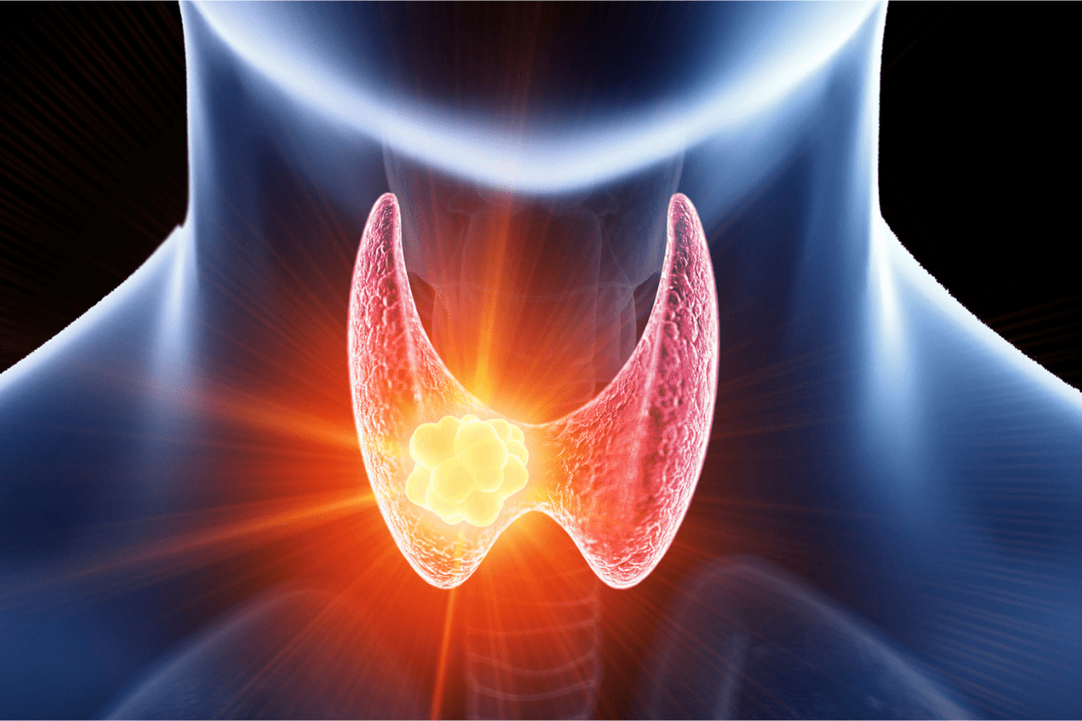 Does Underactive Thyroid Cause Anxiety?