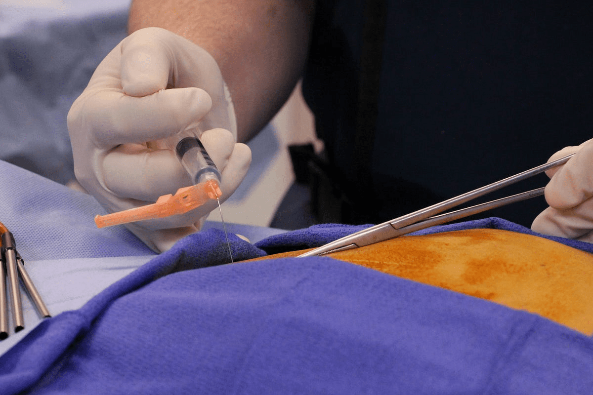 Radiofrequency Ablation Neck: What to Expect