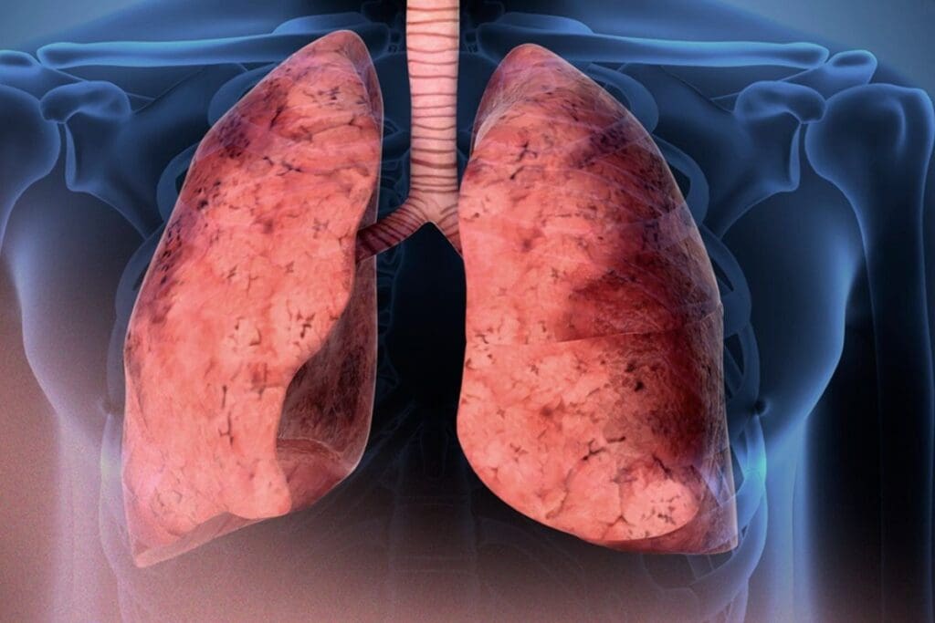 Common Childhood Lung Disease: Look for Signs of Lung Problems