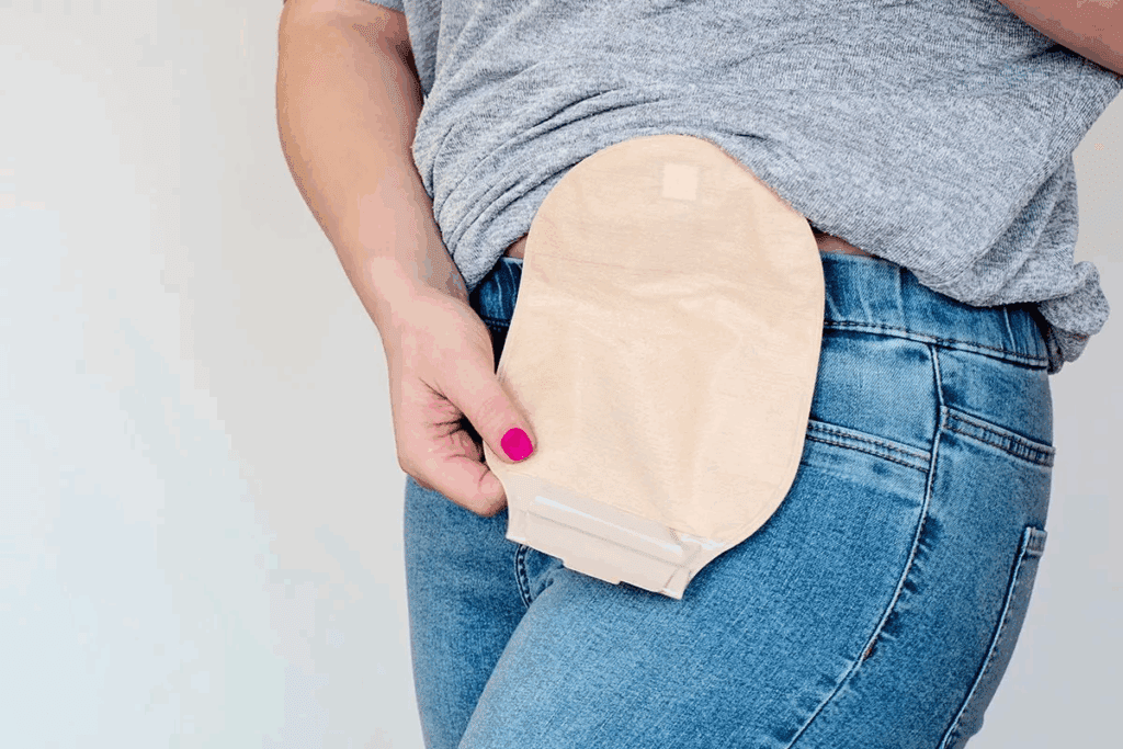 Colostomy Bag: Definition, Types & Meaning