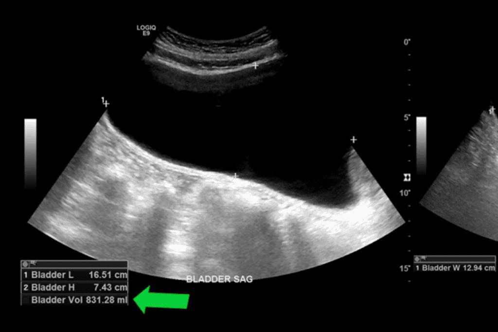 Abnormal PVR: What the PVR Medical Abbreviation Means