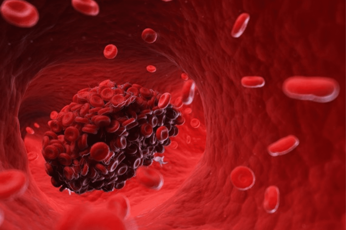 Exercises to Prevent Blood Clots After Surgery