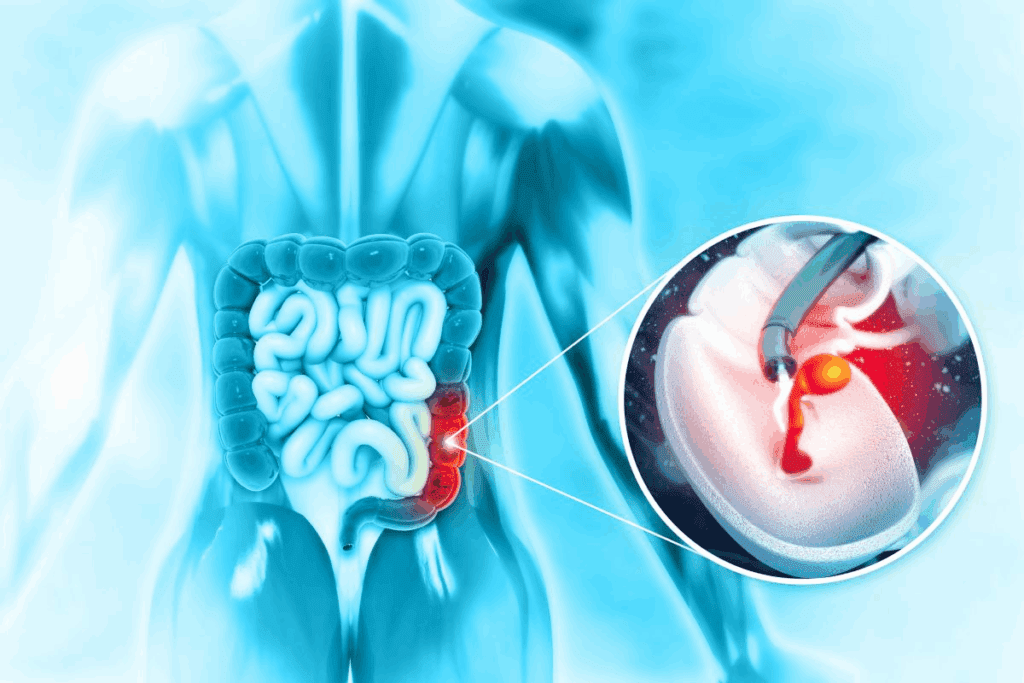 Colostomy Surgery: Types, Causes & Recovery 3 Colostomy Surgery: Types, Causes & Recovery