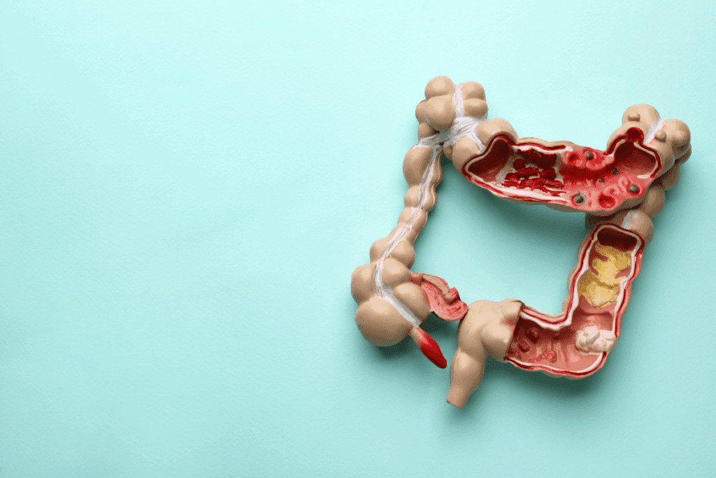 What Is a Colostomy? Procedure & Purpose