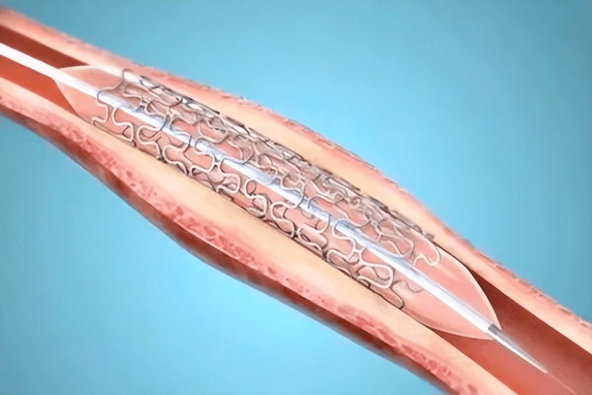 Define Stent Medical: Key Terminology Guide