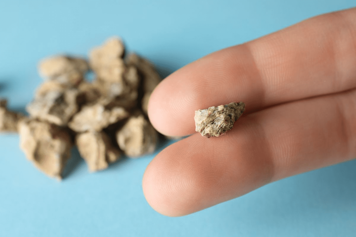 Optimal Kidney Stone Size for Successful ESWL Treatment