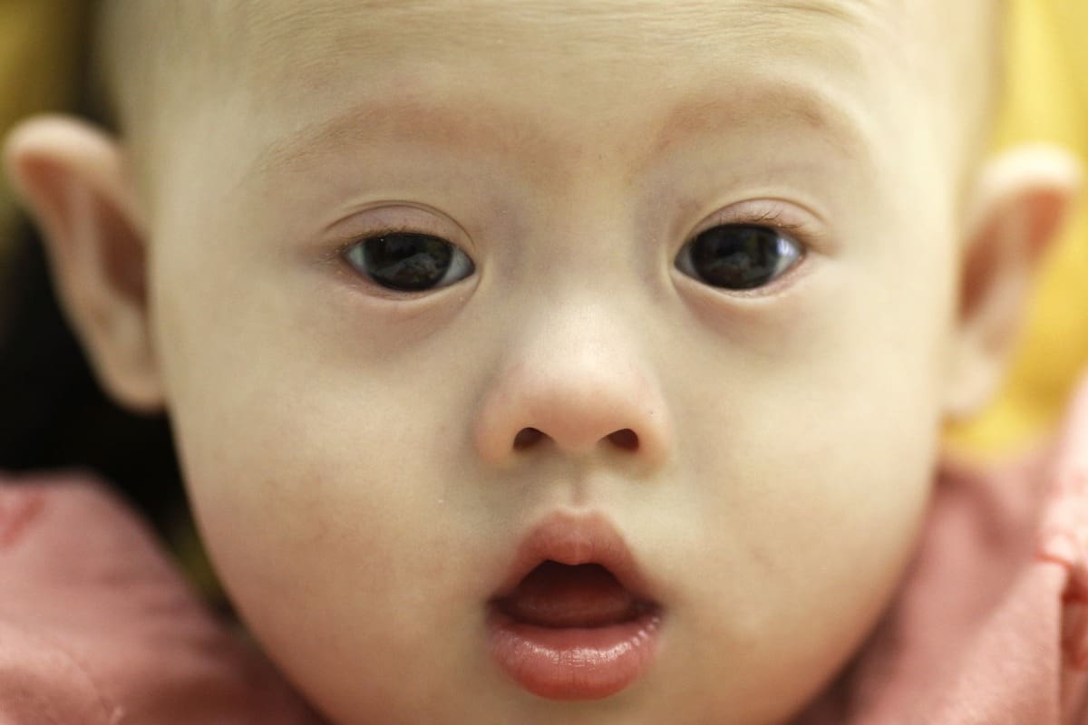 Down Syndrome: A Key Example of a Congenital Anomaly
