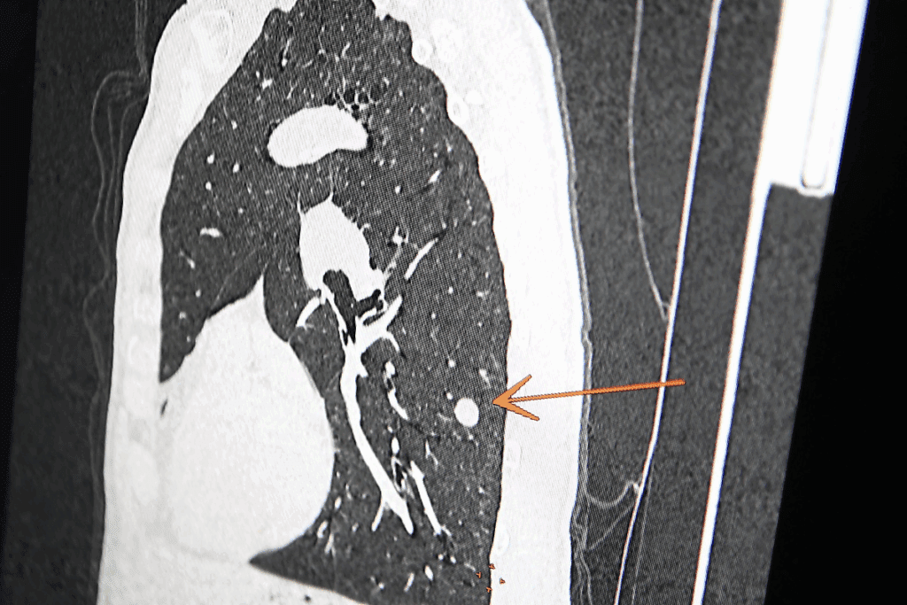 Biopsy of lung nodule: The Ultimate Patient Guide