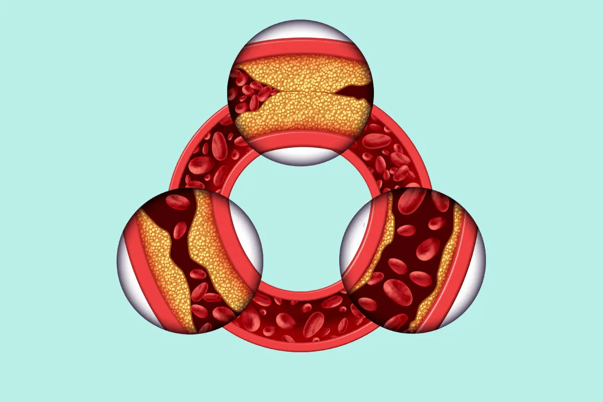 What Causes Plaque to Form in Arteries Naturally