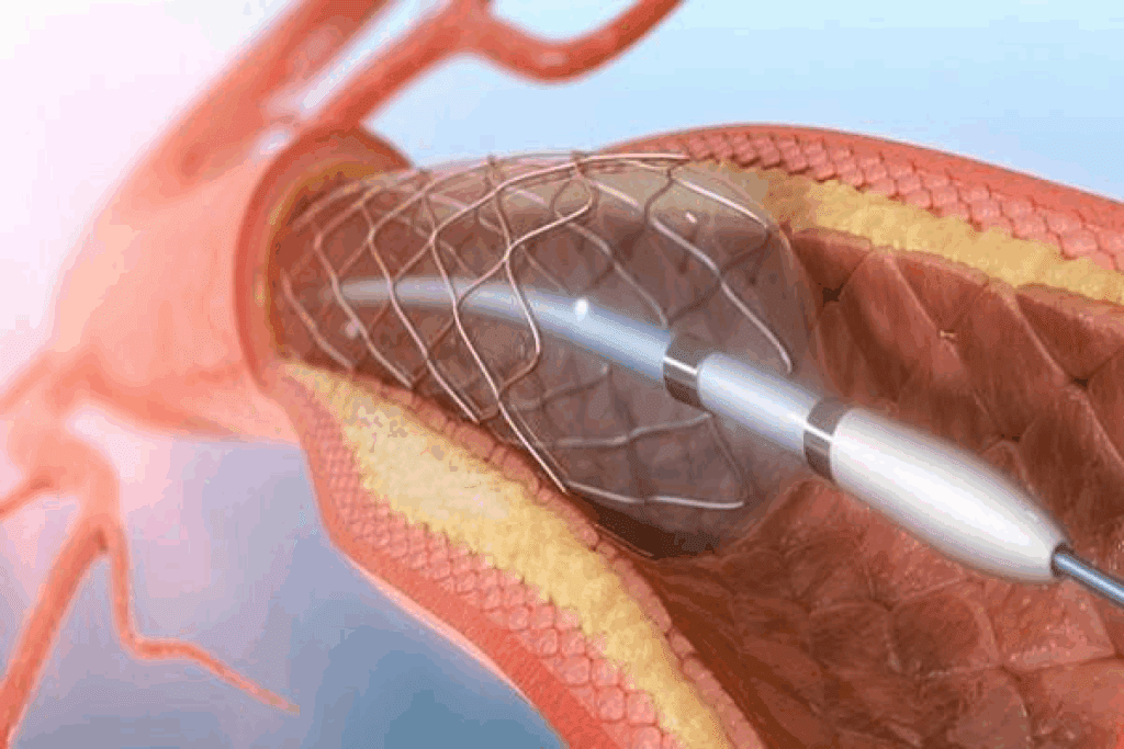 Stint Medical Definition vs Stent: Key Facts