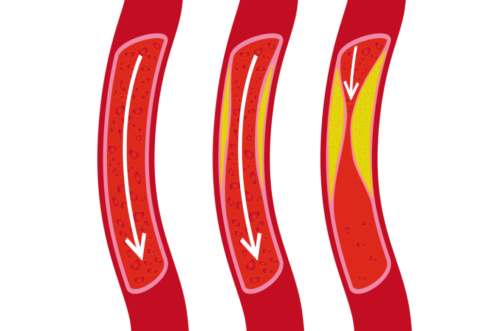 Is CAD the Same as Atherosclerosis? Key Differences
