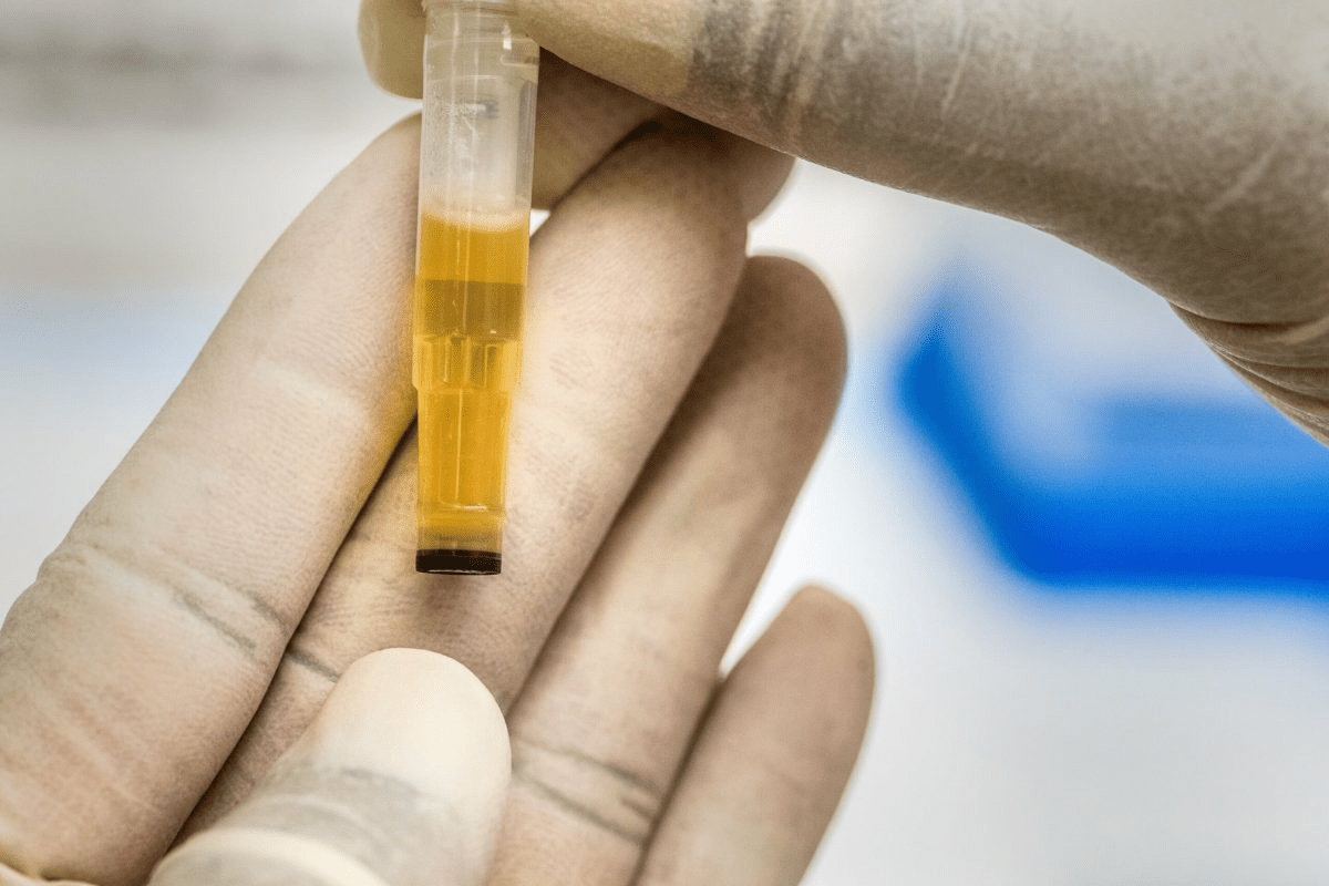 What Illnesses Can Be Detected by a Urine Test?