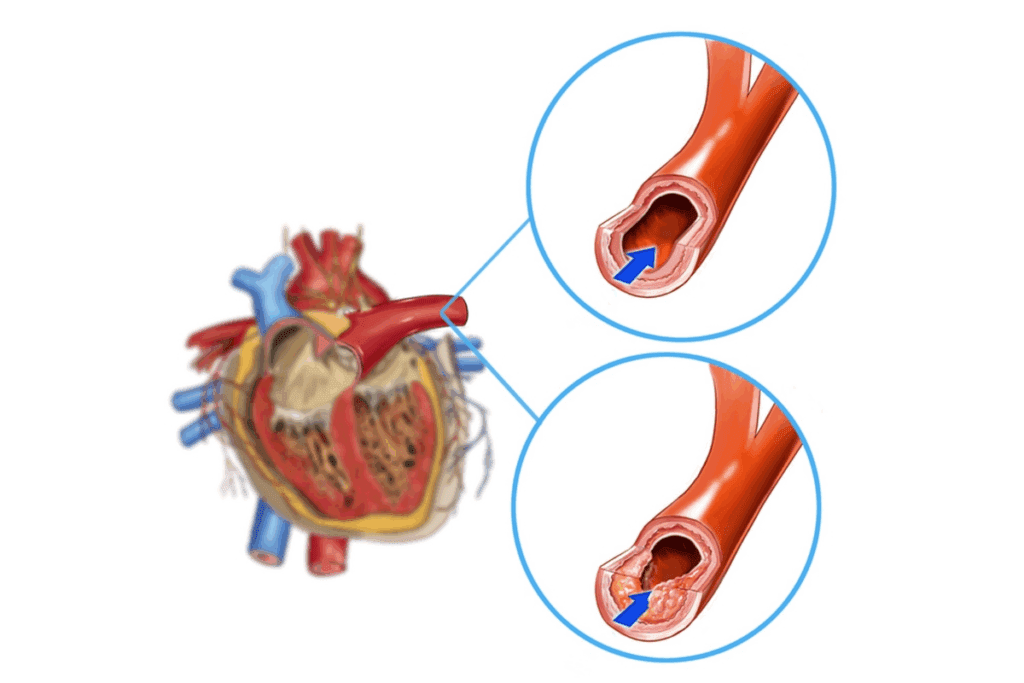 What Causes Soft Plaque in Arteries: 7 Proven Ways