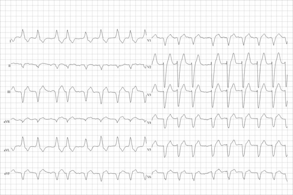 Atrial Fib Flutter: Key Differences Explained 1 Atrial Fib Flutter: Key Differences Explained