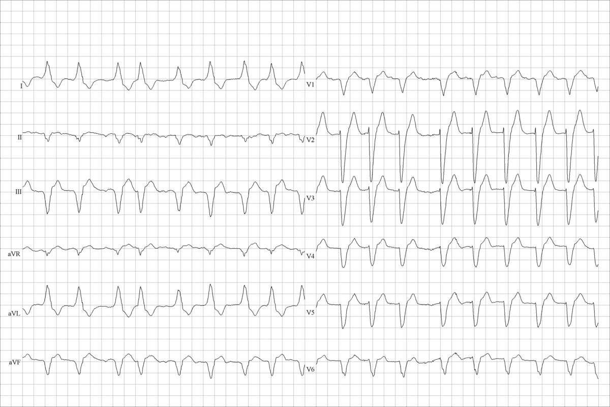 Atrial Fib Flutter: Key Differences Explained