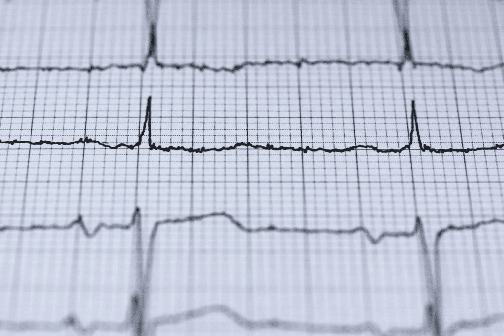 Atrial Tachycardia vs SVT: 7 Key Differences