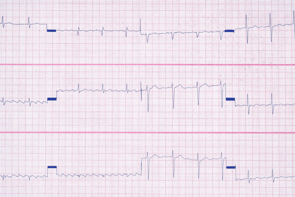 Atrial Tachycardia vs SVT: 7 Key Differences