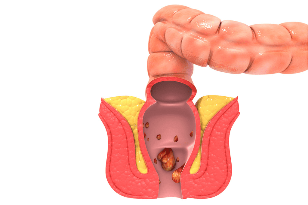 Recognizing Changes: What Does Early Peyronie's Disease Look Like?