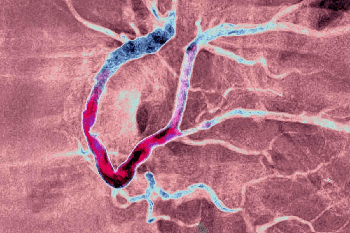 Does Everyone Have Plaque in Their Arteries?