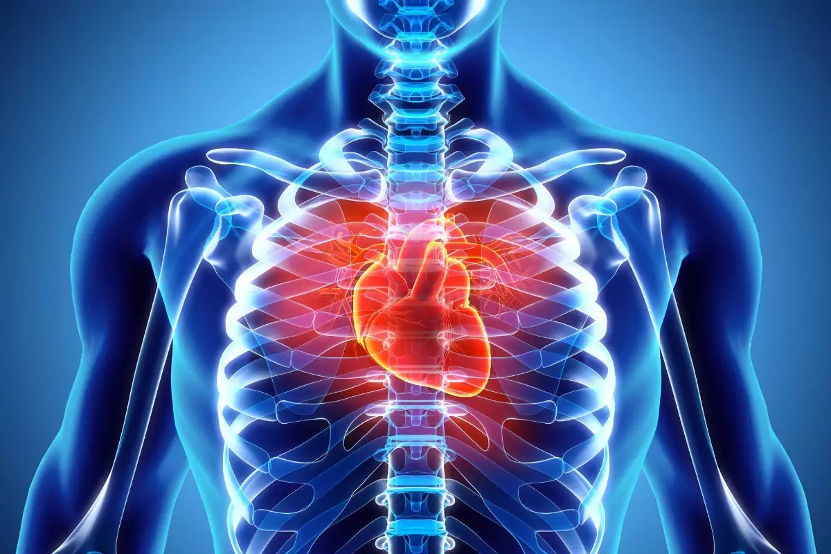Learn what atherosclerotic heart disease of native coronary artery without angina pectoris means.