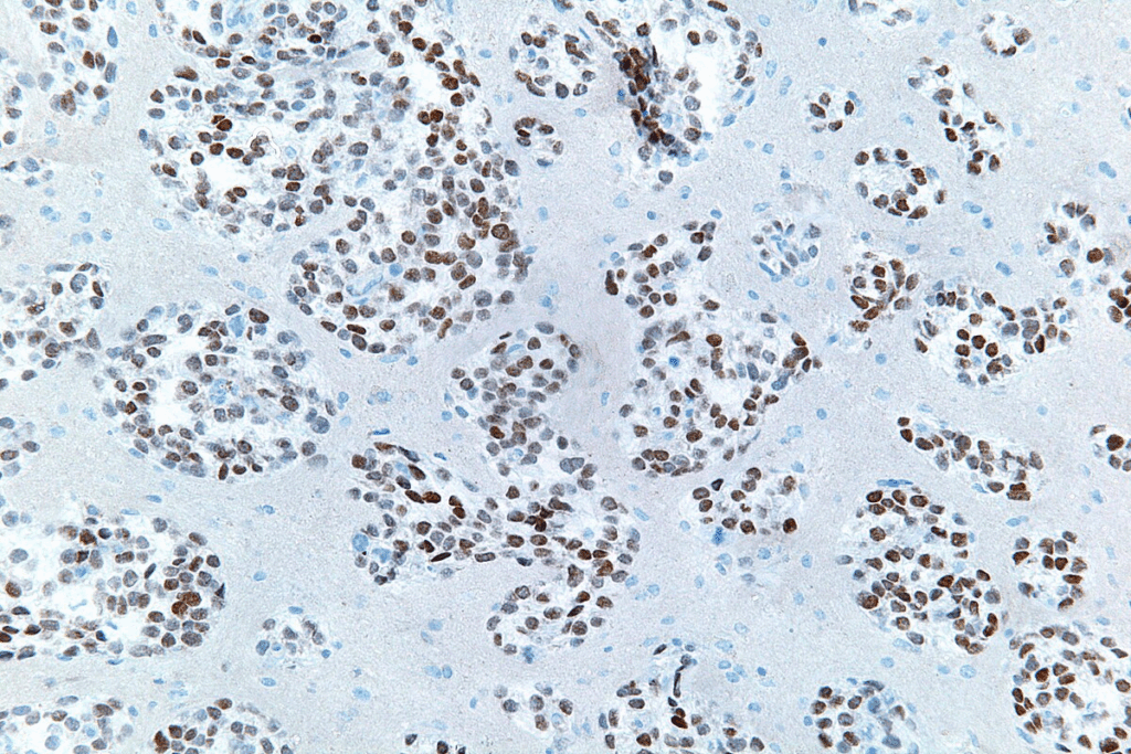 What Causes Plaque Buildup in Arteries: 7 Facts 2 What Causes Plaque Buildup in Arteries: 7 Facts