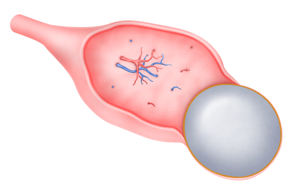Urine Test for a Complex Ovarian Cyst: Is it Possible?