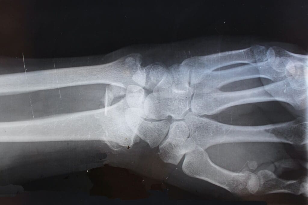 Common Bone Tumor in Kids: Understanding Bone Cancer Diseases