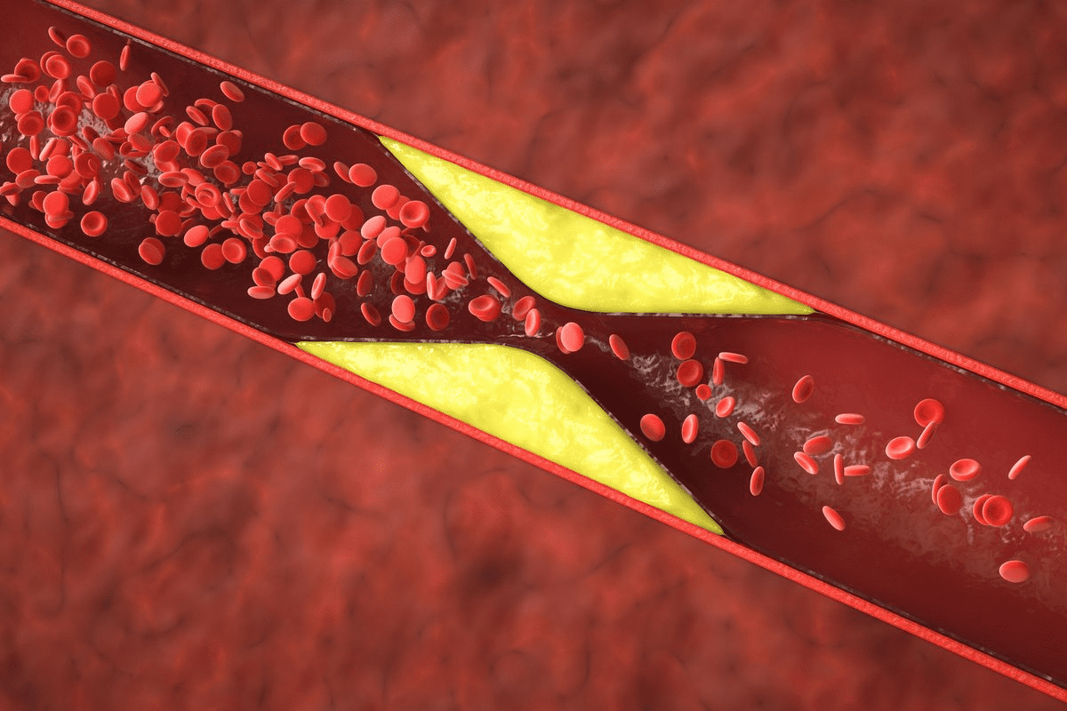 Can You Have Clogged Arteries With Low Cholesterol