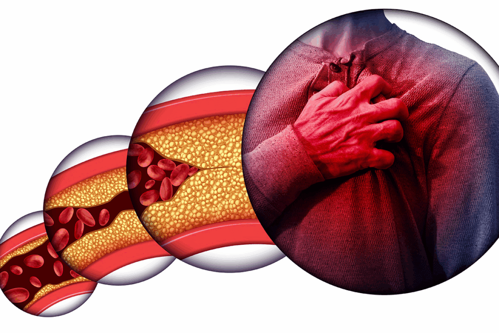 Can You Have Clogged Arteries With Low Cholesterol