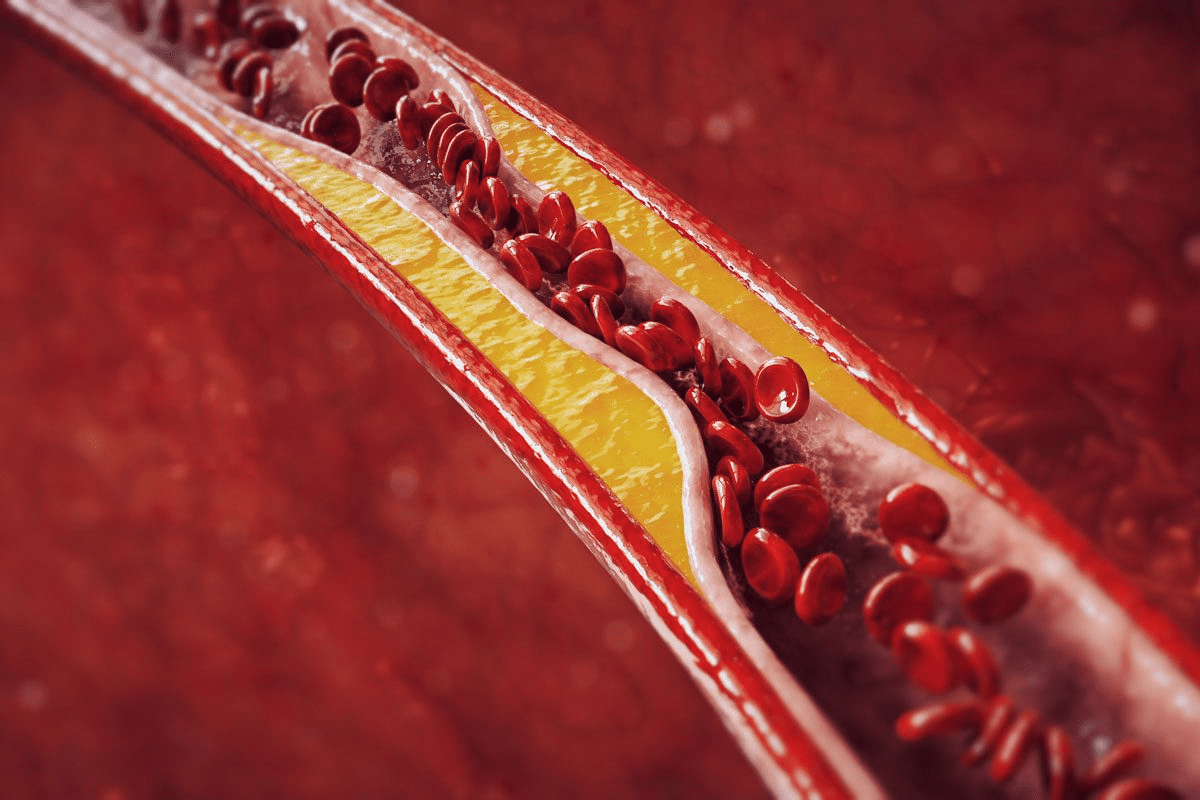 Does Cholesterol Clog Arteries Explained