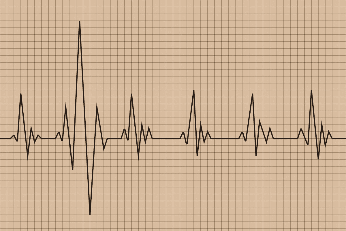 Lethal Arrhythmia: 7 Key Facts to Know