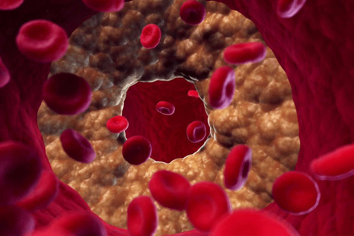 Can You Live a Full Life With Coronary Artery Disease