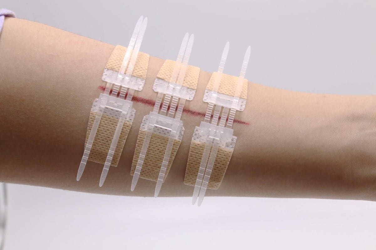 Dissolvable Stitches: The Ultimate Care Secrets